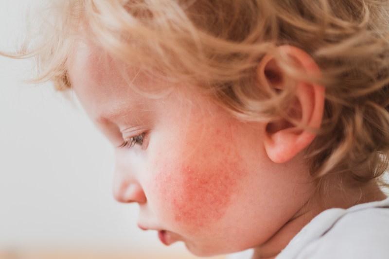 Atopowe zapalenie skóry: przewodnik po leczeniu i pielęgnacji dermy w przypadku tej choroby